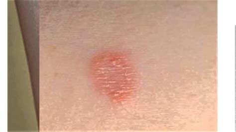 Top Types Of Skin Disease Caused By Fungus Fungal Infection Skin My