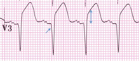 Anterior St Elevation Myocardial Infarction ECG