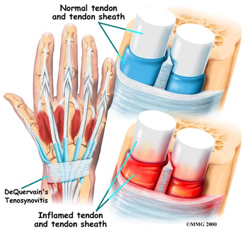 Wrist Tendinitis Specialist Singapore Sports Orthopaedic Surgeon