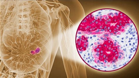 Las células del cáncer de mama reutilizan sus residuos de amoníaco para crecer INVDES