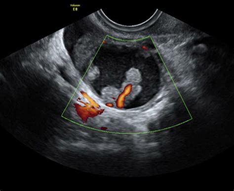 Transvaginal Ultrasound Findings Prior To Initiate Ovarian