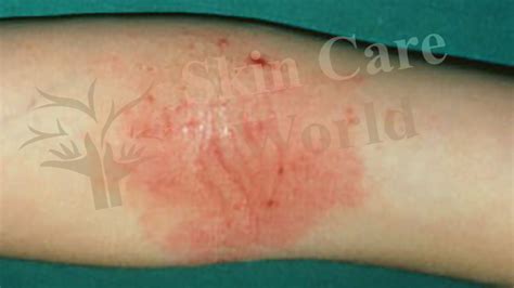 Eczema Bumps On Elbows
