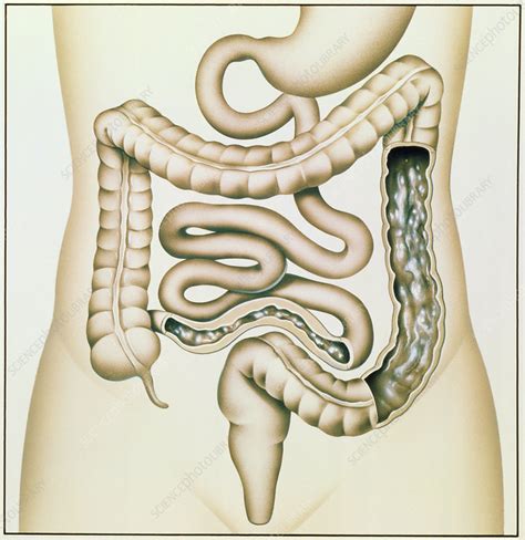 Artwork Of Crohns Disease And Ulcerative Colitis Stock Image M130