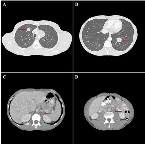 Cureus Testicular Germ Cell Tumor Composed Of Seminoma And Teratoma Metastasizing As