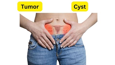 What Is The Difference Between Tumor And Cyst