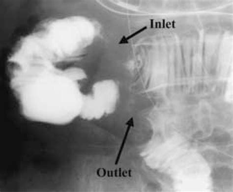 Figure 1 From A Case Of Right Paraduodenal Hernia Originated In The