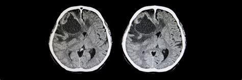Metastatic Brain Tumor Brain Tumor Center Stanford Medicine