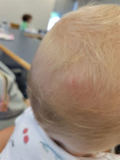 Bump On Head Babycenter