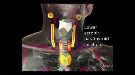 Minimally Invasive Parathyroidectomy Dr James Lee Youtube