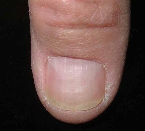 Nail Bed Melanoma Pictures Photos