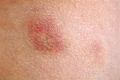 Skin Welt Stock Photos Pictures And Royalty Free Images Istock
