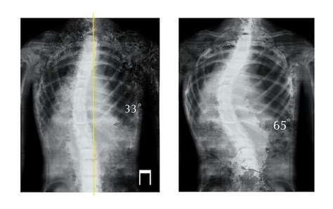 Raios X Da Coluna Vertebral Humana Mostrando Curvatura Pacientes Que