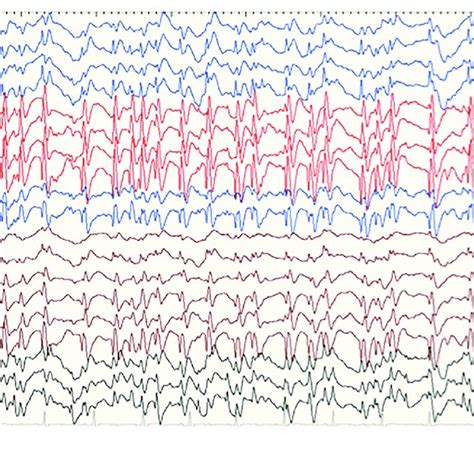 Interictal Eeg In Case 17 With Rars2 Related Disorders At The Age Of