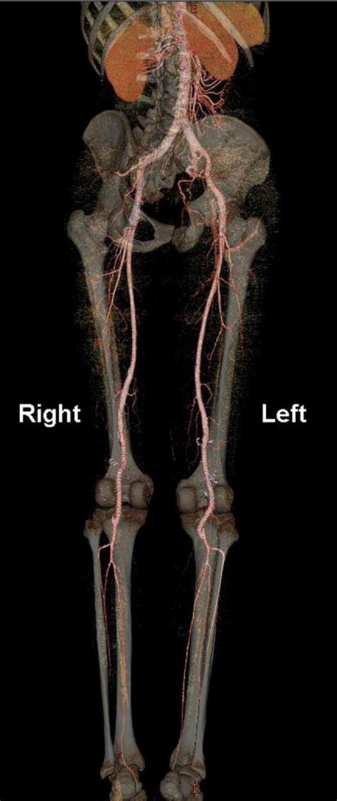 Bilateral Popliteal Artery Aneurysms In A Young Man With Loeys Dietz