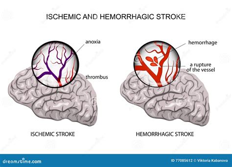 Hemorrhagic And Ischemic Stroke Stock Vector Illustration Of
