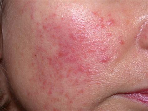 Eczema (associated with dry skin) can result in bumps that may or bumpy dry skin patch: Facial rashes: what's the diagnosis? | Differential ...