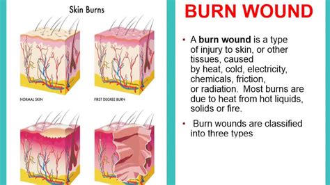 Types Of Burn Wound Youtube