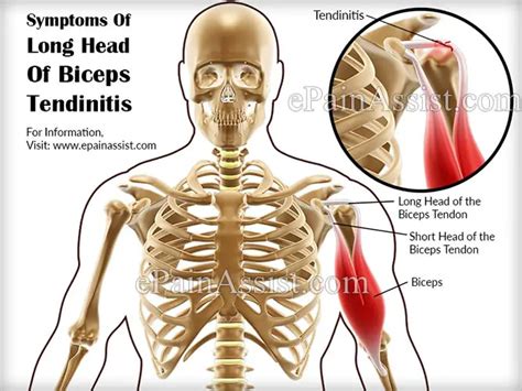 Long Head Of Biceps Tendinitis Treatment Exercises Causes Symptoms