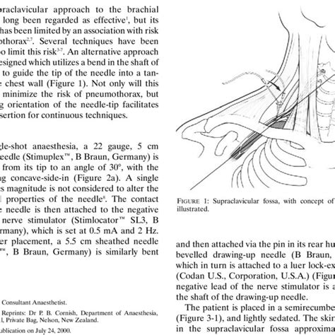 Supraclavicular Fossa With Concept Of Bent Needle Illustrated