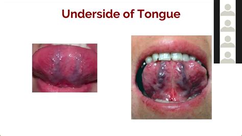 Art Of Ayurveda Tongue Diagnosis 6 Of 9 Under The Tongue Sublingual