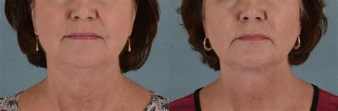 Neck Lift Before And After Pictures Case 244 Tallahassee Fl
