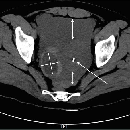 Pdf Diagnostic Utility Of Ct In Differentiating Between Ruptured Ovarian Corpus Luteal Cyst