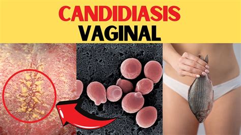 Candidiasis Vaginal Causas Y Como Tratarla YouTube