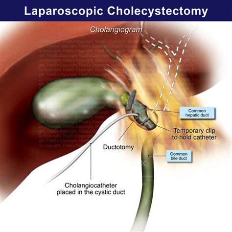 Laparoscopic Cholecystectomy Cholangiogram Trialexhibits Inc