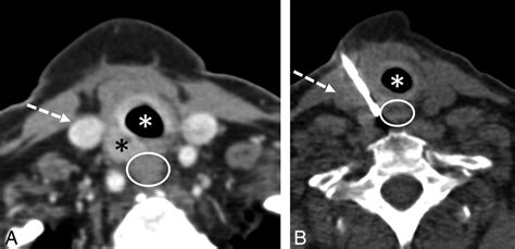 Percutaneous Ct Guided Core Needle Biopsies Of Head And Neck Masses