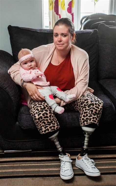 Woman Ends Up With Both Legs Amputated Due To C Section Complication