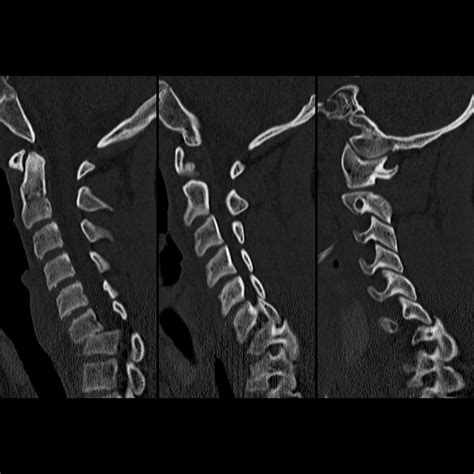 Fracture Dislocation Of The C6 Vertebral Body Pacs