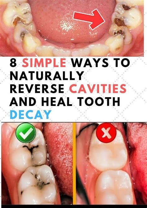 So how can you reverse cavities naturally? Vulgar Tooth Decay Mouths #teethwhiteningmiami # ...