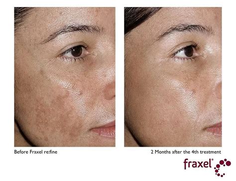 Fraxel Laser For Scars Spots And Stretch Marks