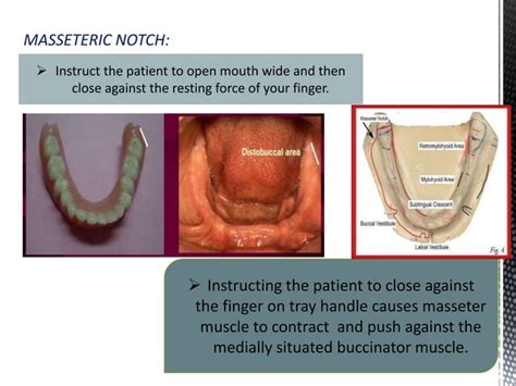 Muscles Surrounding Complete Denture Ppt