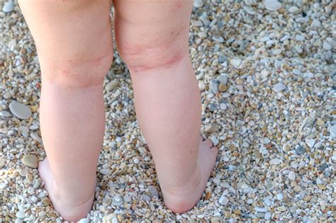 Skin Irritation Newborn Atopic Dermatitis Legs Stock Photo Download