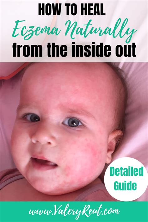 How To Heal Eczema Naturally From The Inside Out Baby Eczema
