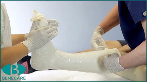 How To Apply A Below Knee Cast Using Plaster Of Paris Youtube