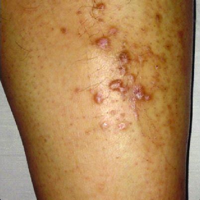 Months Following Discontinuation Of Methotrexate Download Scientific Diagram