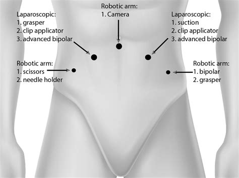 The Position Of The Trocars Is Similar To The Laparoscopic Radical Download Scientific Diagram