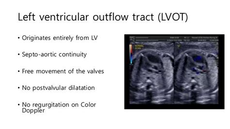 Right Outflow Tract Ultrasoundको लागि तस्बिर परिणाम Fetal Ultrasound