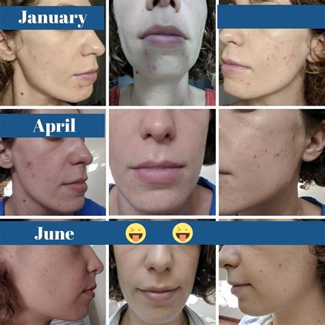 Banda Evolution And Disappearance Over Six Months Of Cystic Acne On