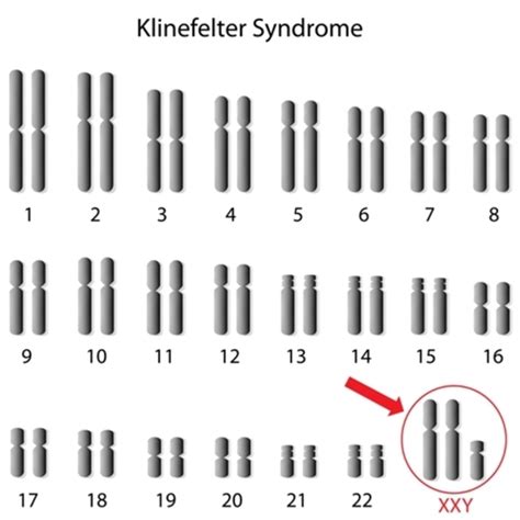 Klinefelter Syndrome Medlineplus Genetics