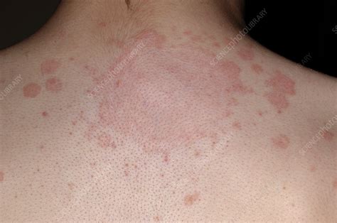 Ringworm Fungal Infection Stock Image M2700313 Science Photo Library