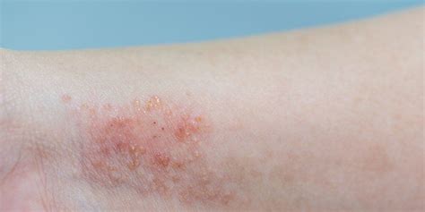 Ease Your Itchy Skin With These 8 Best Eczema Treatments Prevention