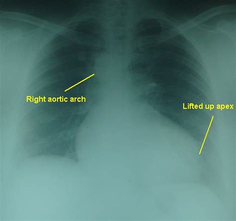 Tetralogy Of Fallot Right Aortic Arch X Ray Chest Pa View