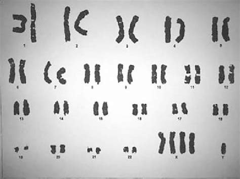 49 xxxxy karyotype gtg banding download scientific diagram