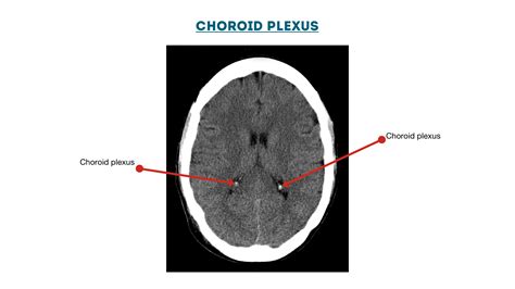 Choroid Plexus Diagram Geeky Medics