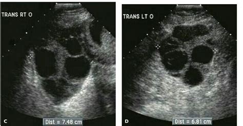 Transverse Images Of The C Right And D Left Ovaries Reveal Multiple