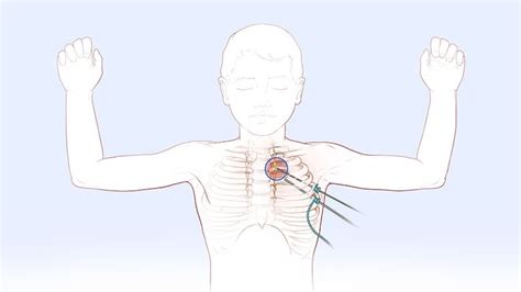 Thoracoscopic Sympathectomy Hyperhidrosis Surgery For Children And