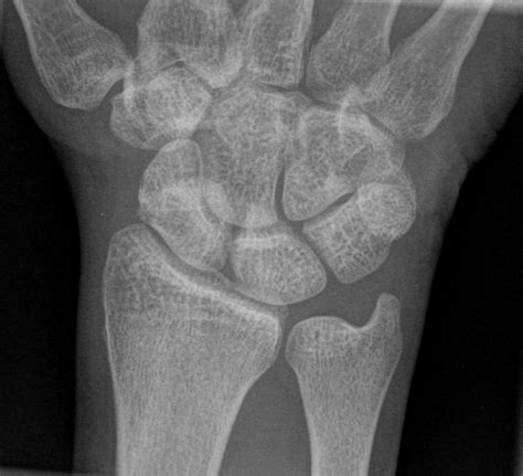 Wrist Pain That Should Not Be Missed The Bmj